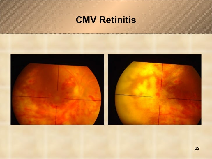 normal retina vs cmv retinitis