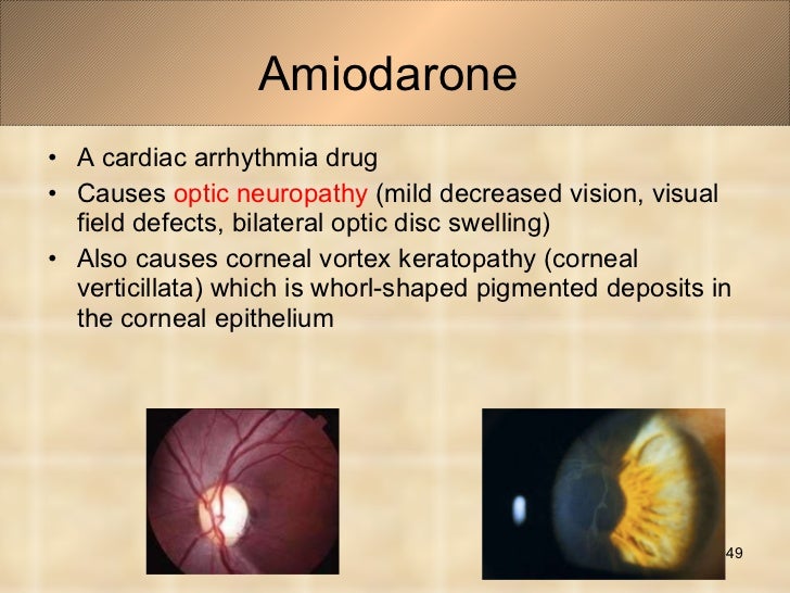 Amiodarone Optic Neuropathy
