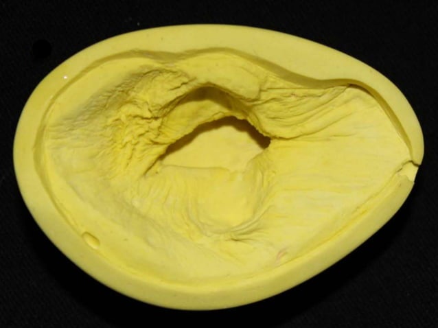 Ocular Prosthesis Fabrication | PPTX | Eye and Vision Conditions ...