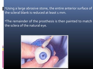 •Using a large abrasive stone, the entire anterior surface of
the scleral blank is reduced at least 1 mm.
•The remainder of the prosthesis is then painted to match
the sclera of the natural eye.
 