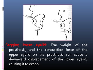 Sagging lower eyelid: The weight of the
prosthesis, and the contraction force of the
upper eyelid on the prosthesis can cause a
downward displacement of the lower eyelid,
causing it to droop.
 