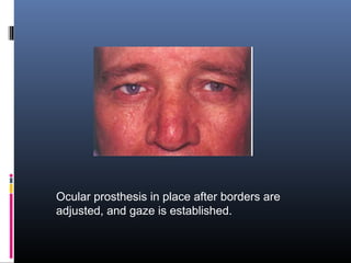 Ocular prosthesis in place after borders are
adjusted, and gaze is established.
 