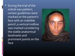  During the trial of the
scleral wax pattern,
certain guidelines were
marked on the patient’s
face with an indelible
pencil ,a vertical midline
was marked considering
the stable anatomical
landmarks and
prominent points on the
face
 