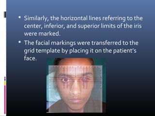  Similarly, the horizontal lines referring to the
center, inferior, and superior limits of the iris
were marked.
 The facial markings were transferred to the
grid template by placing it on the patient’s
face.
 