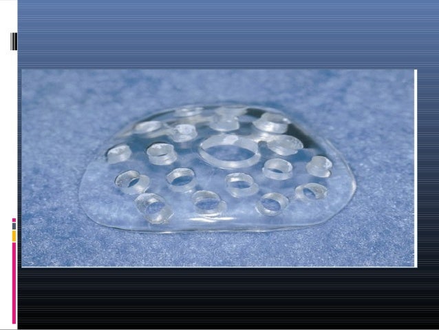 ocular prothesis ocular prothesis