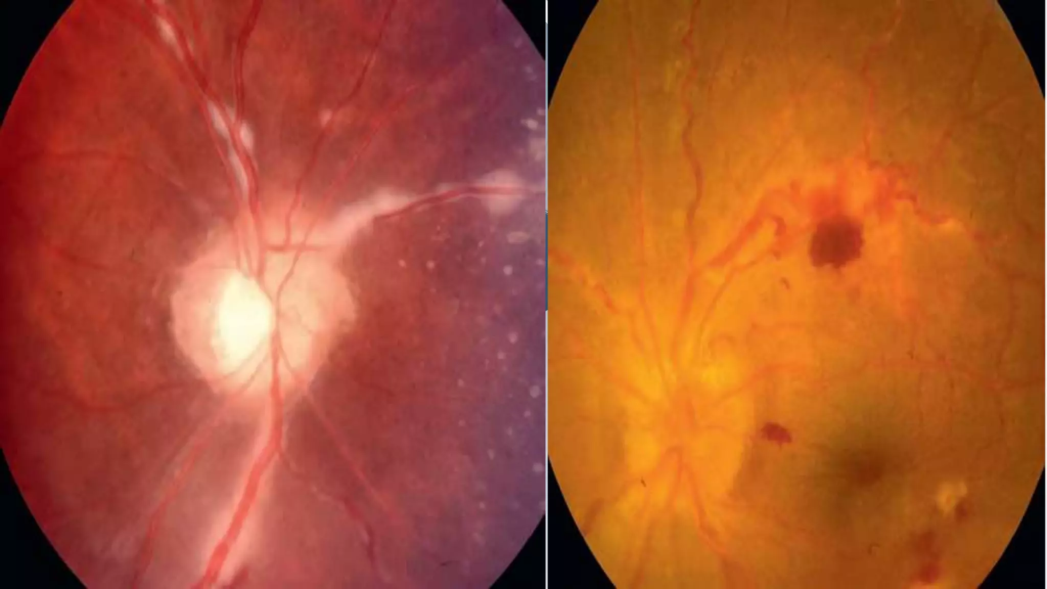 Cular Ransom Ocular Sarcoidosis In Patients Without Symptoms Rare In Finland – JYNFLT
