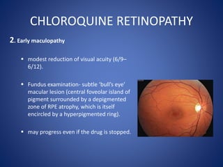CHLOROQUINE RETINOPATHY
2. Early maculopathy
 modest reduction of visual acuity (6/9–
6/12).
 Fundus examination- subtle...