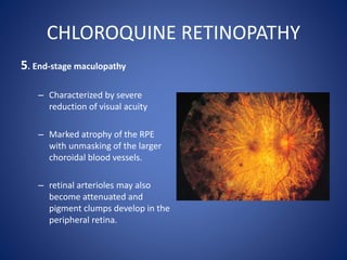 CHLOROQUINE RETINOPATHY
5. End-stage maculopathy
– Characterized by severe
reduction of visual acuity
– Marked atrophy of ...