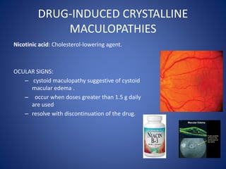 DRUG-INDUCED CRYSTALLINE
MACULOPATHIES
Nicotinic acid: Cholesterol-lowering agent.
OCULAR SIGNS:
– cystoid maculopathy sug...