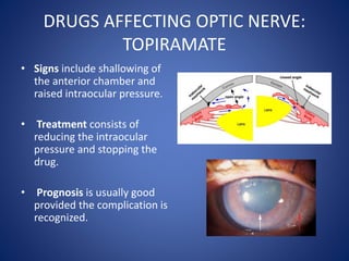DRUGS AFFECTING OPTIC NERVE:
TOPIRAMATE
• Signs include shallowing of
the anterior chamber and
raised intraocular pressure...