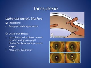 Tamsulosin
alpha-adrenergic blockers
 Indications:
• Benign prostate hypertrophy
 Ocular Side Effects:
• Loss of tone in...