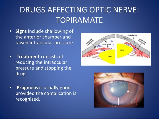Topiramate Medication Side Effects