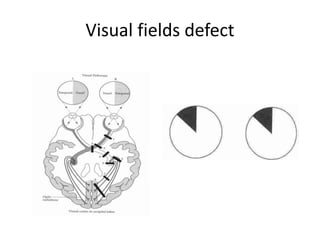 Visual Field Defect Fill In Ocular signs in medicine/ neurology | PPTX
