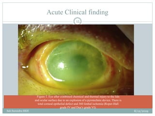 Acute Clinical finding
8/12/2019Sah Surendra HEH
15
Figure 1. Eye after combined chemical and thermal injury to the lids
and ocular surface due to an explosion of a pyrotechnic device. There is
total corneal epithelial defect and 360 limbal ischemia (Roper-Hall
grade IV and Dua’s grade VI).
 