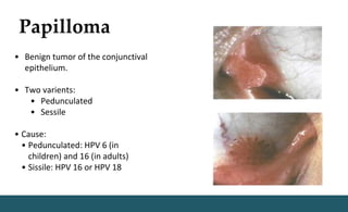 Papilloma
• Benign tumor of the conjunctival
epithelium.
• Two varients:
• Pedunculated
• Sessile
• Cause:
• Pedunculated: HPV 6 (in
children) and 16 (in adults)
• Sissile: HPV 16 or HPV 18
 