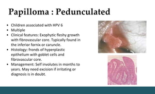 Papilloma : Pedunculated
• Children associated with HPV 6
• Multiple
• Clinical features: Exophytic fleshy growth
with fibrovascular core. Typically found in
the inferior fornix or caruncle.
• Histology: fronds of hyperplastic
epithelium with goblet cells and
fibrovascular core.
• Management: Self involutes in months to
years. May need excision if irritating or
diagnosis is in doubt.
 