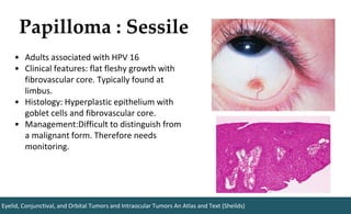 Papilloma : Sessile
Eyelid, Conjunctival, and Orbital Tumors and Intraocular Tumors An Atlas and Text (Sheilds)
• Adults associated with HPV 16
• Clinical features: flat fleshy growth with
fibrovascular core. Typically found at
limbus.
• Histology: Hyperplastic epithelium with
goblet cells and fibrovascular core.
• Management:Difficult to distinguish from
a malignant form. Therefore needs
monitoring.
 