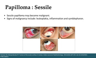 Papilloma : Sessile
Honavar SG, Manjandavida FP. Tumors of the ocular surface: A review. Indian Journal of Ophthalmology. 2015;63(3):187-203. doi:10.4103/0301-
4738.156912.
• Sessile papilloma may become malignant.
• Signs of malignancy include: leukoplakia, inflammation and symblepharon.
 