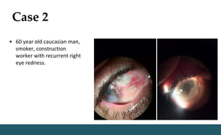 Case 2
• 60 year old caucasian man,
smoker, construction
worker with recurrent right
eye redness.
 