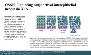 OSSN : Replacing conjunctival intraepithelial
neoplasia (CIN)
Lee GA, Hirst LW. Ocular surface squamous neoplasia. Survey of Ophthalmology 1995;39(6):429-50
AAO BCSC 2015: Ophthalmic Pathology and Intraouclar Tumours.
The term OSSN first used
by Lee at el. In 1995:
Ocular surface squamous
neoplasia presents as a
spectrum from simple
dysplasia to carcinoma in
situ to invasive squamous
cell carcinoma involving
the conjunctiva as well as
the cornea.
 