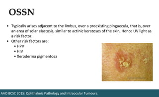 OSSN
AAO BCSC 2015: Ophthalmic Pathology and Intraocular Tumours.
• Typically arises adjacent to the limbus, over a preexisting pinguecula, that is, over
an area of solar elastosis, similar to actinic keratoses of the skin, Hence UV light as
a risk factor.
• Other risk factors are:
• HPV
• HIV
• Xeroderma pigmentosa
 