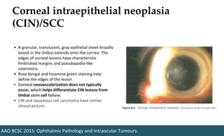 Corneal intraepithelial neoplasia
(CIN)/SCC
AAO BCSC 2015: Ophthalmic Pathology and Intraocular Tumours.
• A granular, translucent, gray epithelial sheet broadly
based at the limbus extends onto the cornea. The
edges of corneal lesions have characteristic
fimbriated margins and pseudopodia-like
extensions.
• Rose bengal and lissamine green staining help
define the edges of the lesion.
• Corneal neovascularization does not typically
occur, which helps differentiate CIN lesions from
limbal stem cell failure.
• CIN and squamous cell carcinoma have similar
clinical picture.
 