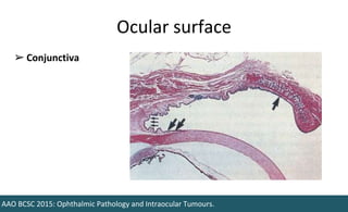 Ocular surface
AAO BCSC 2015: Ophthalmic Pathology and Intraocular Tumours.
➢ Conjunctiva
 