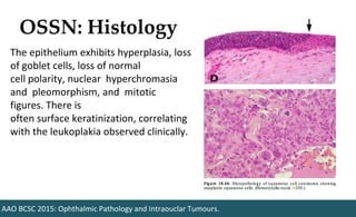 OSSN: Histology
AAO BCSC 2015: Ophthalmic Pathology and Intraouclar Tumours.
The epithelium exhibits hyperplasia, loss
of goblet cells, loss of normal
cell polarity, nuclear hyperchromasia
and pleomorphism, and mitotic
figures. There is
often surface keratinization, correlating
with the leukoplakia observed clinically.
 
