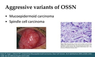 Aggressive variants of OSSN
• Mucoepidermoid carcinoma
• Spindle cell carcinoma
Kapur R, Sugar J, Edward DP. Conjunctival Mucoepidermoid Carcinoma: Clear Cell Variant. Arch Ophthalmol.2005;123(9):1265–
1268. doi:10.1001/archopht.123.9.1265
 