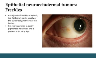 Epithelial neuroectodermal tumors:
Freckles
• A conjunctival freckle, or ephelis,
is a flat brown patch, usually of
the bulbar conjunctiva near the
limbus.
• It is more common in darkly
pigmented individuals and is
present at an early age.
 