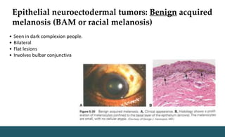 Epithelial neuroectodermal tumors: Benign acquired
melanosis (BAM or racial melanosis)
• Seen in dark complexion people.
• Bilateral
• Flat lesions
• Involves bulbar conjunctiva
 