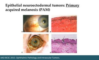 Epithelial neuroectodermal tumors: Primary
acquired melanosis (PAM)
AAO BCSC 2015: Ophthalmic Pathology and Intraocular Tumors.
 