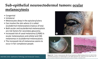 Sub-epithelial neuroectodermal tumors: ocular
melanocytosis
• Congenital
• Unilateral
• Melanocytes deep in the episclera/sclera
• Can involve the skin where it is called
oculodermal melanocytosis (naevus of ota)
• Both ocular and oculardermal melanocytosis
are risk factors for secondary glaucoma.
• Increased risk of uveal melanoma (1/400) in
ocular melanocytosis and orbital and CNS
melanomas in oculodermal melanocytosis.
• The increased risk of melanomas seems to
occur in fair complexion people.
AAO BCSC 2015: Ophthalmic Pathology and Intraocular Tumors.
 