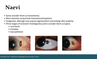 Naevi
• Some consider them as hamartomas.
• Most common conjunctival hamartoma/neoplasm
• Congenital, although may acquire pigmentation and enlarge after puberty.
• Three stages of evolution histologically (some consider them as types):
• Junctional
• Complex
• Sub-epithelial
AAO BCSC 2015: Ophthalmic Pathology and Intraocular Tumors.
 