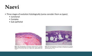 Naevi
• Three stages of evolution histologically (some consider them as types):
• Junctional
• Complex
• Sub-epithelial
 