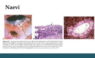 Naevi
 