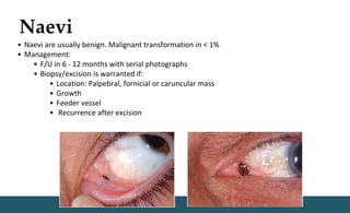 Naevi
• Naevi are usually benign. Malignant transformation in < 1%
• Management:
• F/U in 6 - 12 months with serial photographs
• Biopsy/excision is warranted if:
• Location: Palpebral, fornicial or caruncular mass
• Growth
• Feeder vessel
• Recurrence after excision
 