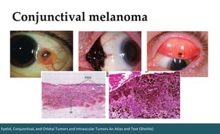 Conjunctival melanoma
Eyelid, Conjunctival, and Orbital Tumors and Intraocular Tumors An Atlas and Text (Sheilds)
 