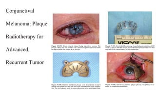 Conjunctival
Melanoma: Plaque
Radiotherapy for
Advanced,
Recurrent Tumor
 