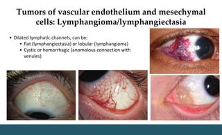 Tumors of vascular endothelium and mesechymal
cells: Lymphangioma/lymphangiectasia
• Dilated lymphatic channels, can be:
• flat (lymphangiectasia) or lobular (lymphangioma)
• Cystic or hemorrhagic (anomolous connection with
venules)
 