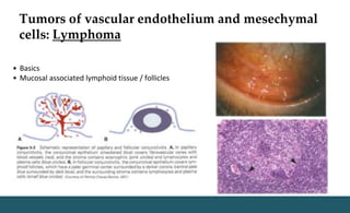 Tumors of vascular endothelium and mesechymal
cells: Lymphoma
• Basics
• Mucosal associated lymphoid tissue / follicles
 
