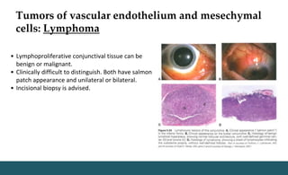 Tumors of vascular endothelium and mesechymal
cells: Lymphoma
• Lymphoproliferative conjunctival tissue can be
benign or malignant.
• Clinically difficult to distinguish. Both have salmon
patch appearance and unilateral or bilateral.
• Incisional biopsy is advised.
 