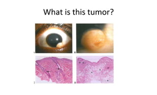 What is this tumor?
 