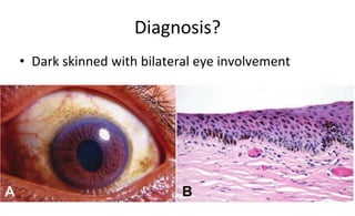 Diagnosis?
• Dark skinned with bilateral eye involvement
 