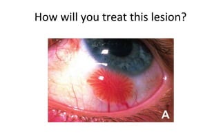 How will you treat this lesion?
 