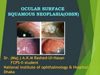 OCULAR SURFACE
SQUAMOUS NEOPLASIA(OSSN)
Dr. (Maj.) A.K.M Rashed-Ul-Hasan
FCPS-ll student
National institute of ophthalmology & Hospital
Dhaka
 