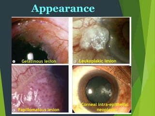 Gelatinous lesion Leukoplakic lesion
Papillomatous lesion
Corneal intra-epithelial
neoplasia
Appearance
 