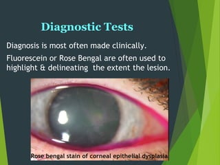 Diagnostic Tests
Diagnosis is most often made clinically.
Fluorescein or Rose Bengal are often used to
highlight & delineating the extent the lesion.
Rose bengal stain of corneal epithelial dysplasia
 
