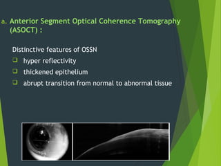 a. Anterior Segment Optical Coherence Tomography
(ASOCT) :
Distinctive features of OSSN
 hyper reflectivity
 thickened epithelium
 abrupt transition from normal to abnormal tissue
 