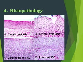 d. Histopathology
Mild dysplasia Severe dysplasia
Carcinoma in situ Invasive SCC
 